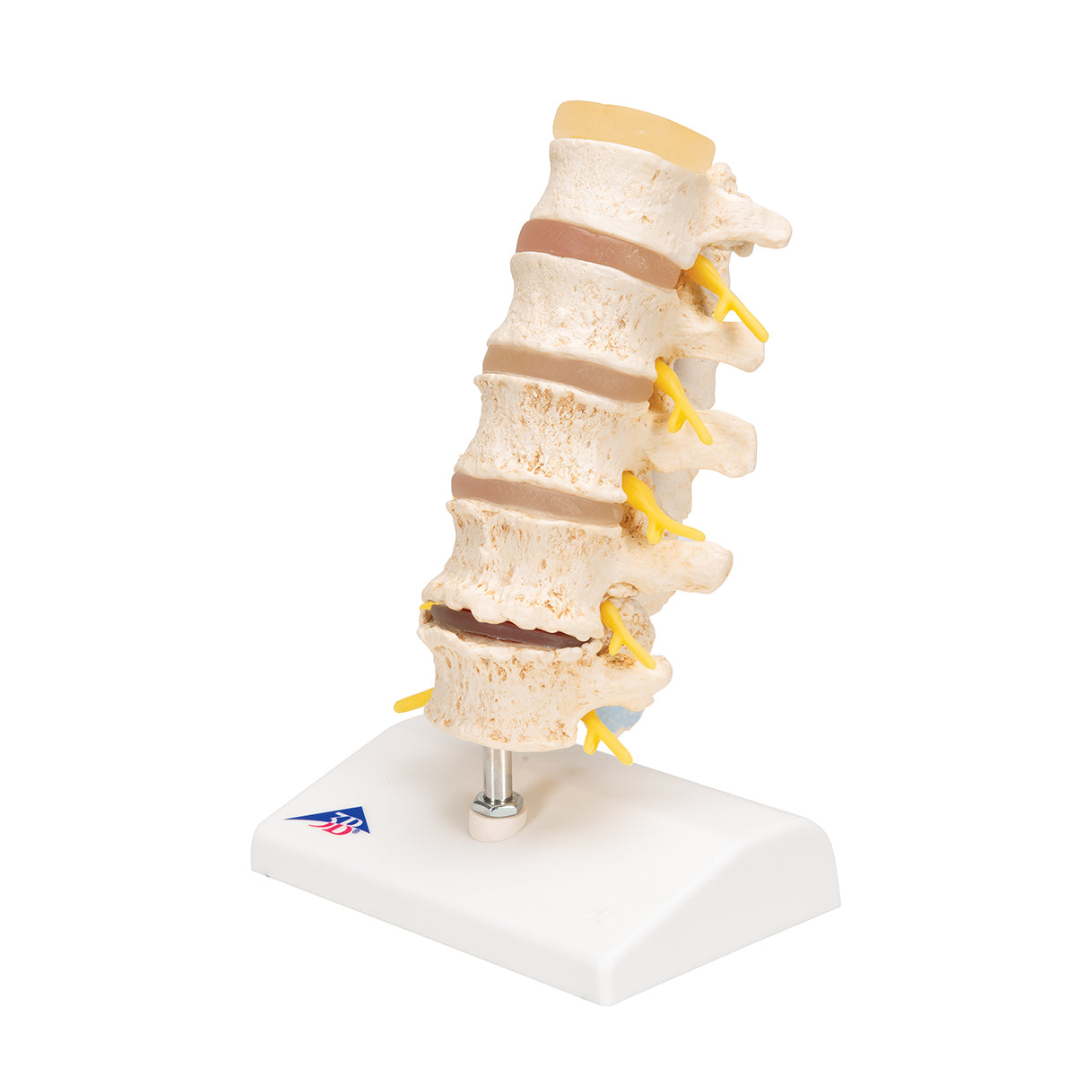 Stages of disc prolapse and vertebral degeneration - 3B Scientific A795, view 5