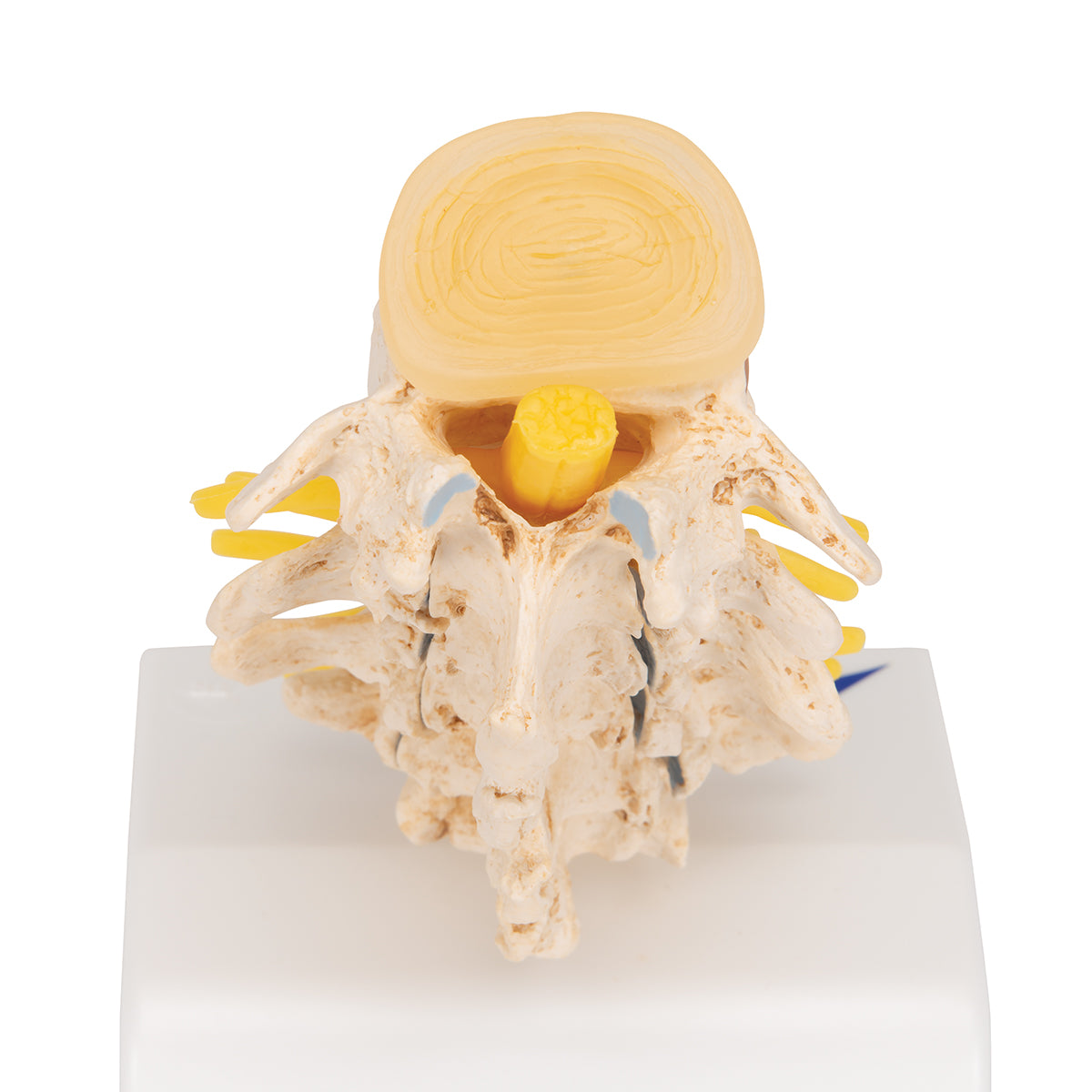 Stages of disc prolapse and vertebral degeneration - 3B Scientific A795, view 7