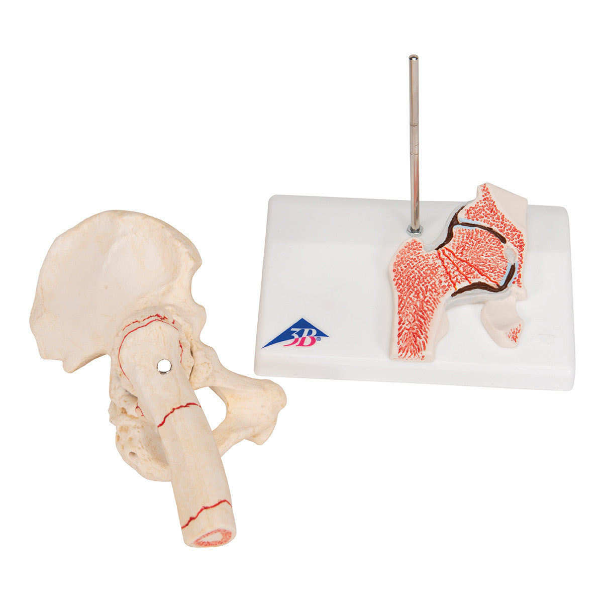 Human Femoral Fracture & Hip Osteoarthritis Model