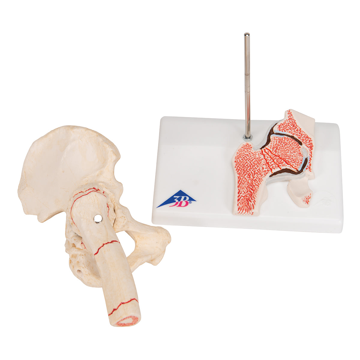 Human Femoral Fracture & Hip Osteoarthritis Model - 3B Scientific A88, view 5