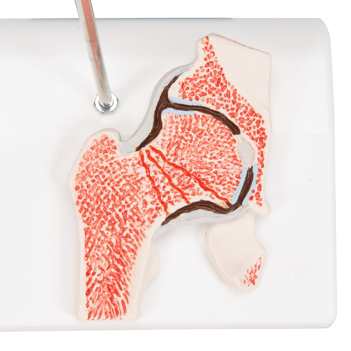 Human Femoral Fracture & Hip Osteoarthritis Model - 3B Scientific A88, view 6