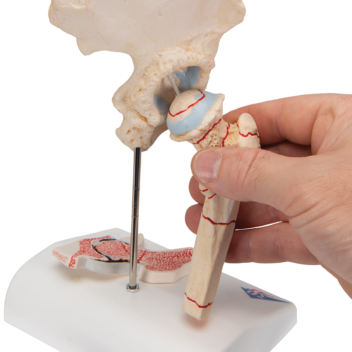 Human Femoral Fracture & Hip Osteoarthritis Model - 3B Scientific A88, view 7