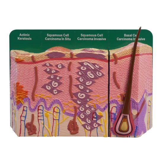 Skin Cancer Model