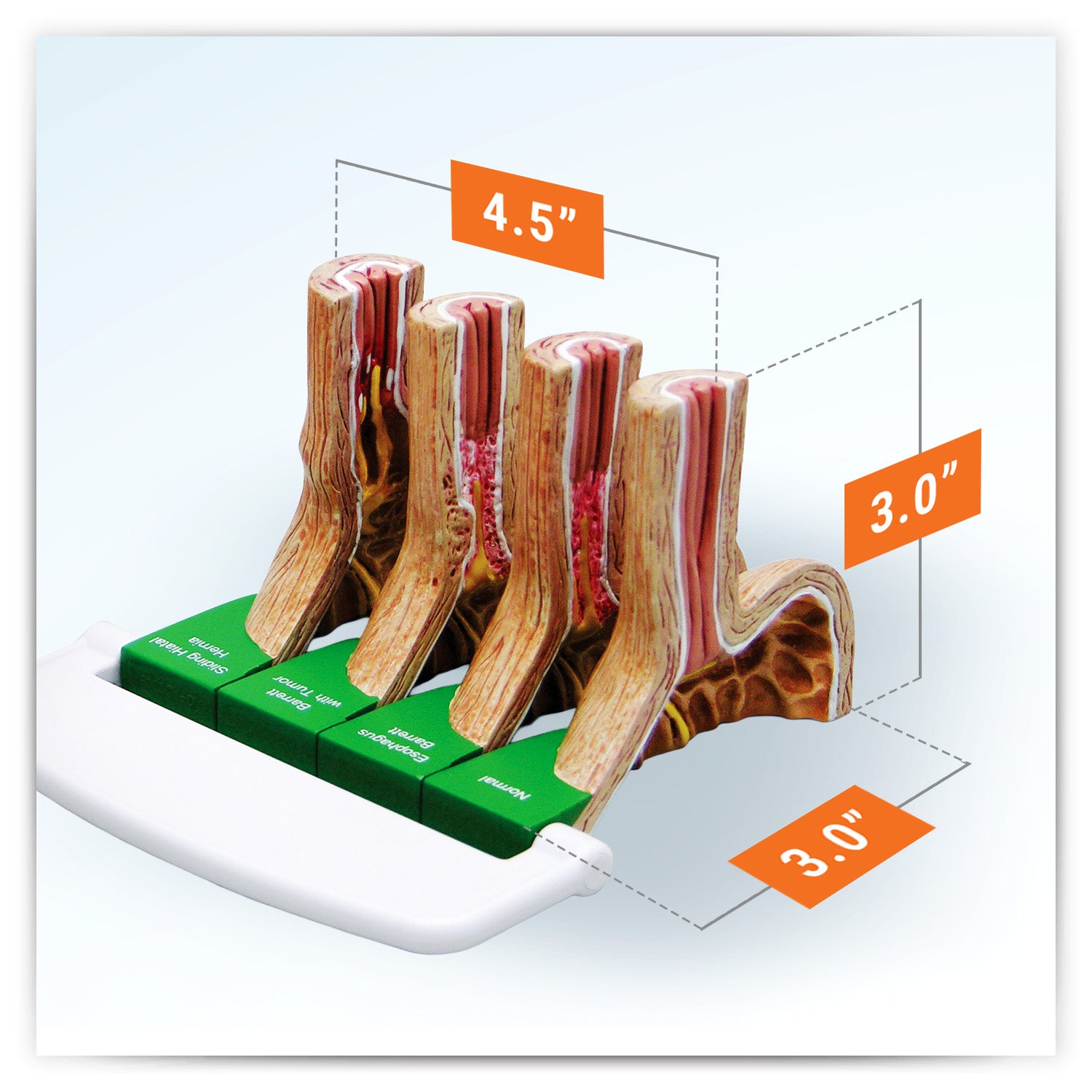 4-Piece GERD (Gastroesphageal Reflux Disease)