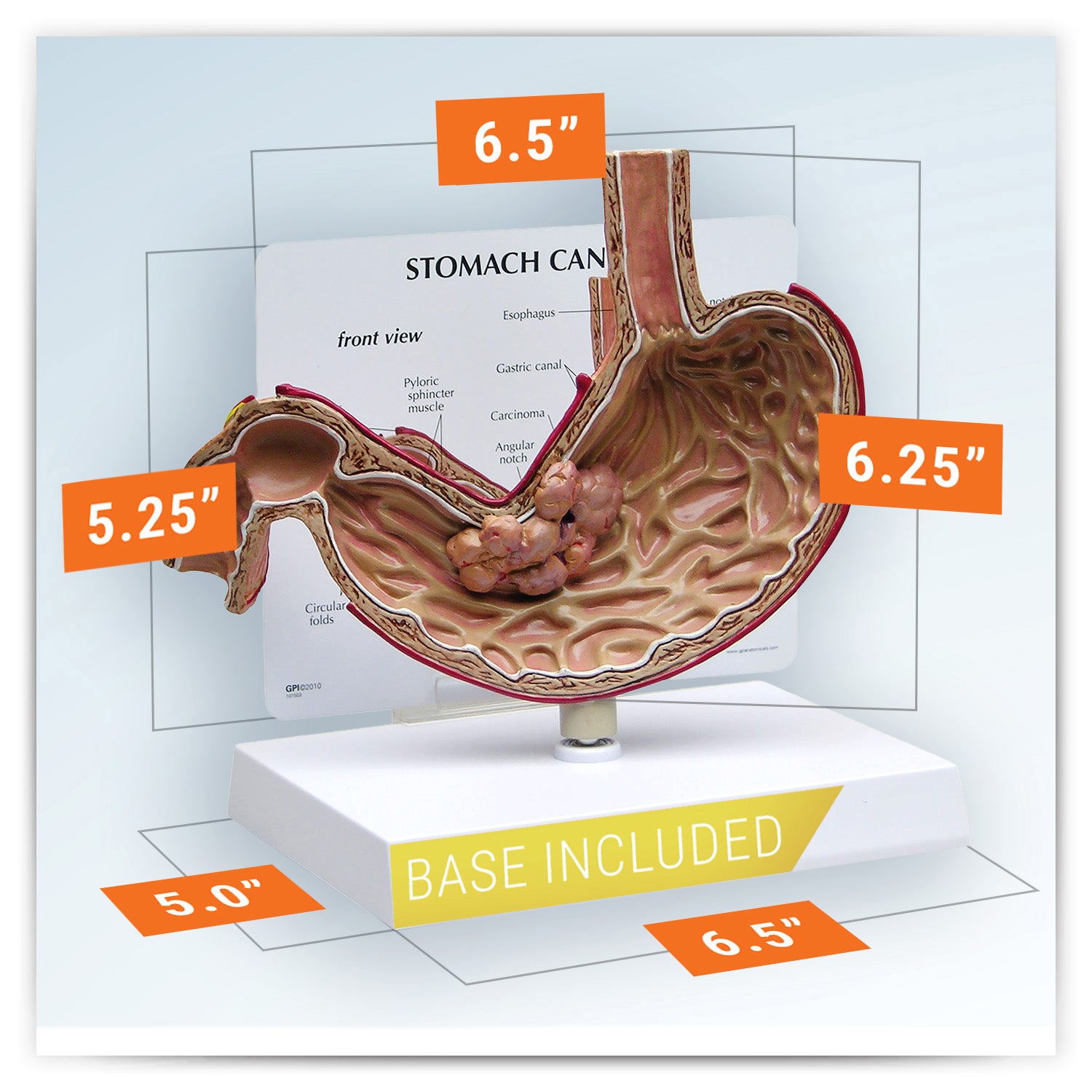 Stomach Cancer