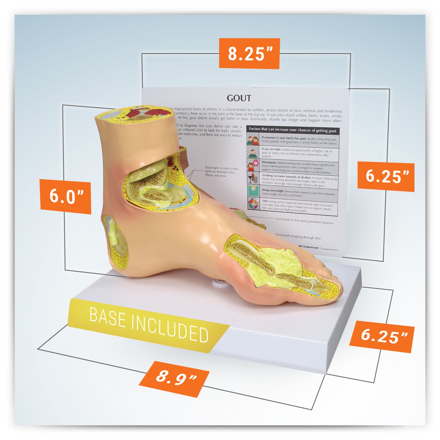 Gout (Foot)