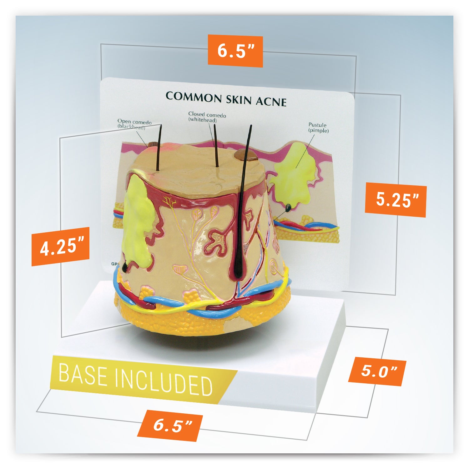 Common Skin Acne