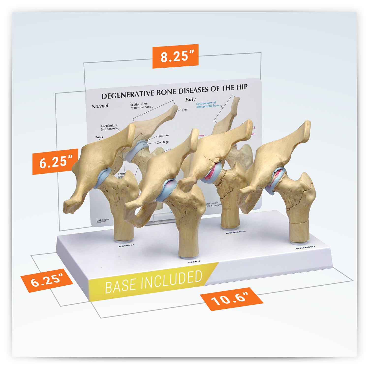 4-Stage Degenerative Hip Set