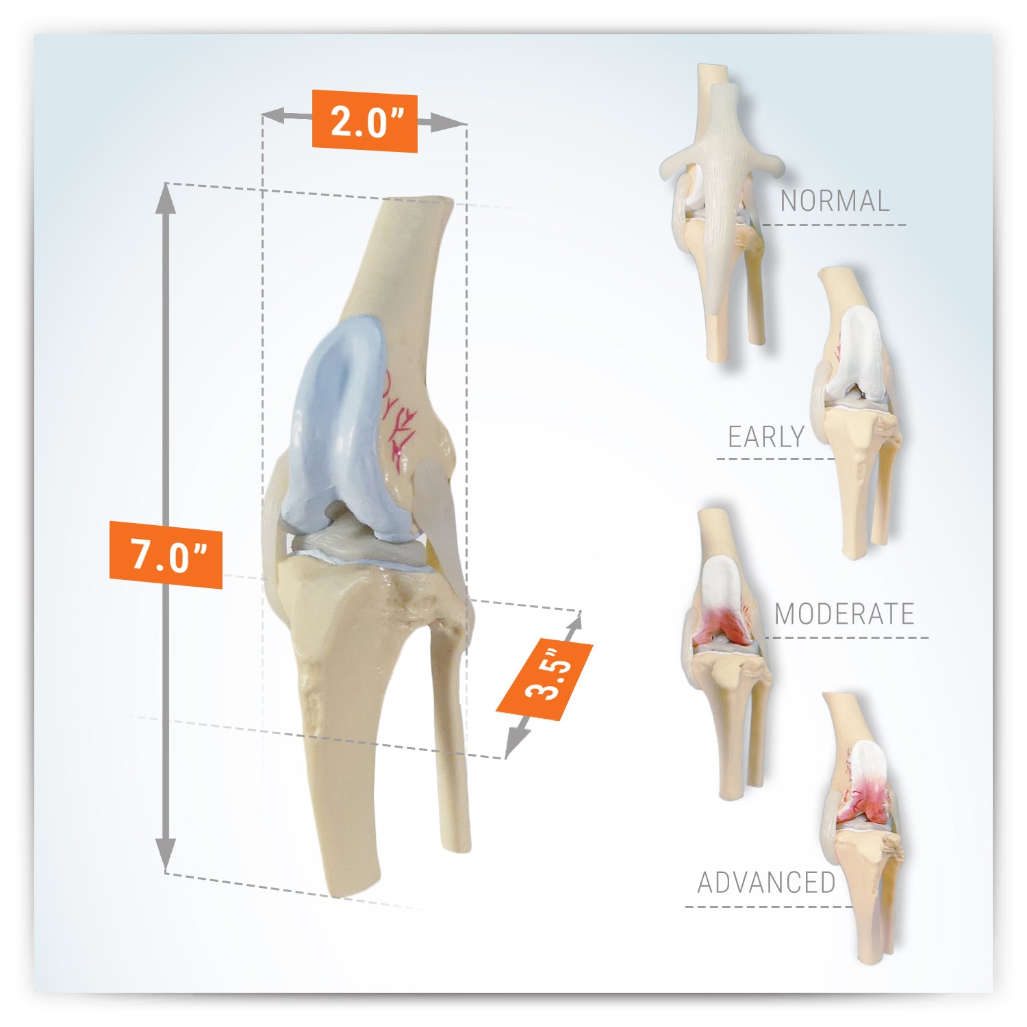 4-Stage Osteoarthritis (OA) Canine Knee Set