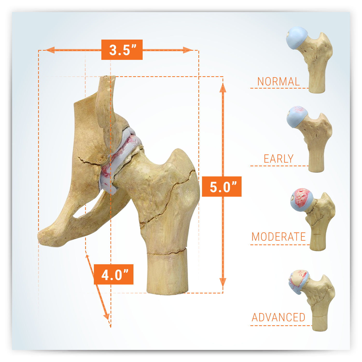 4-Stage Degenerative Hip Set