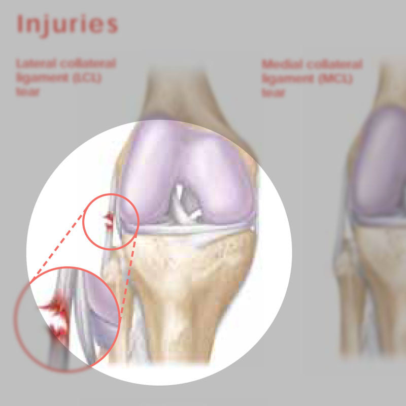 Athletic Injuries of the Knee chart - detail