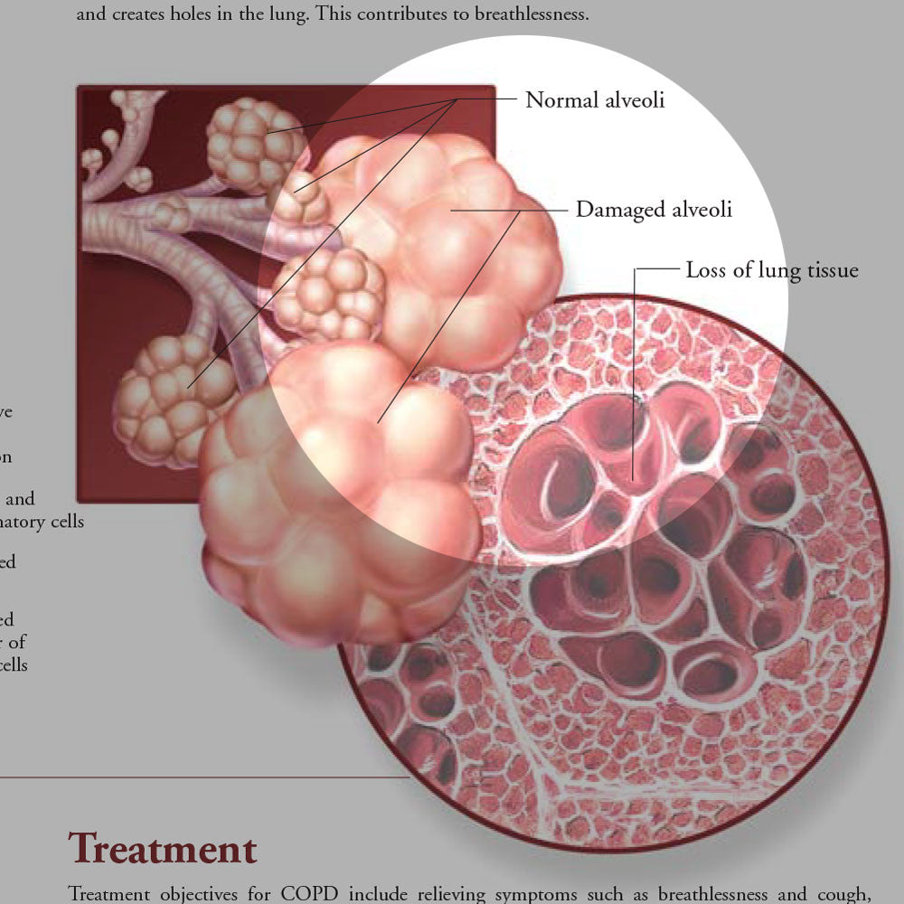 COPD-04-1000-1000__97297.1604090600.1280.1280.jpg