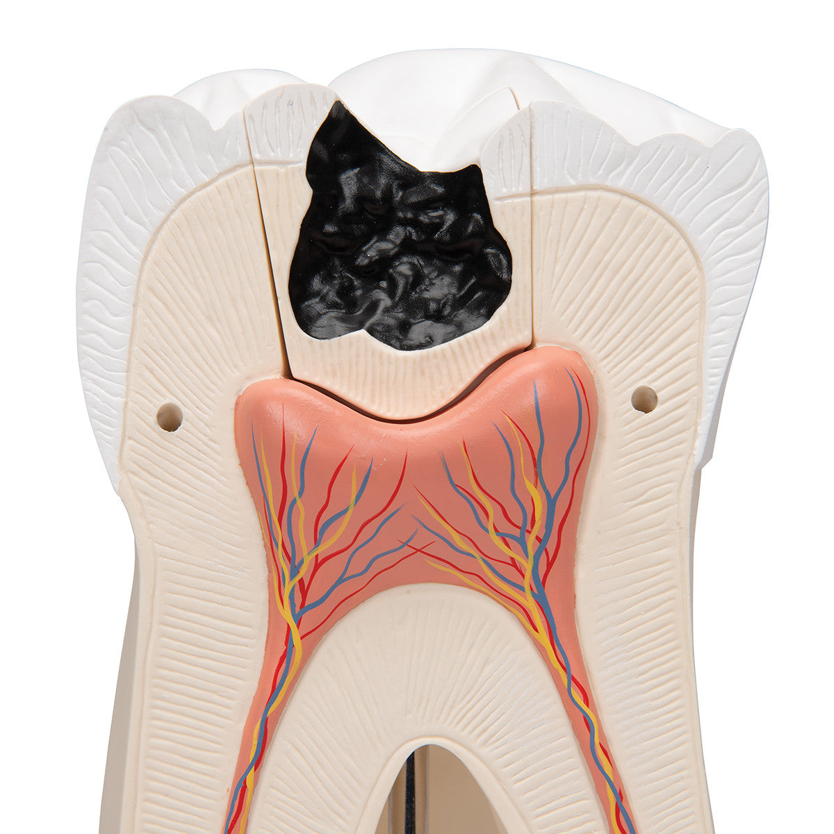 Giant Molar with Dental Cavities Human Tooth Model, 15 times Life-Size, 6 part