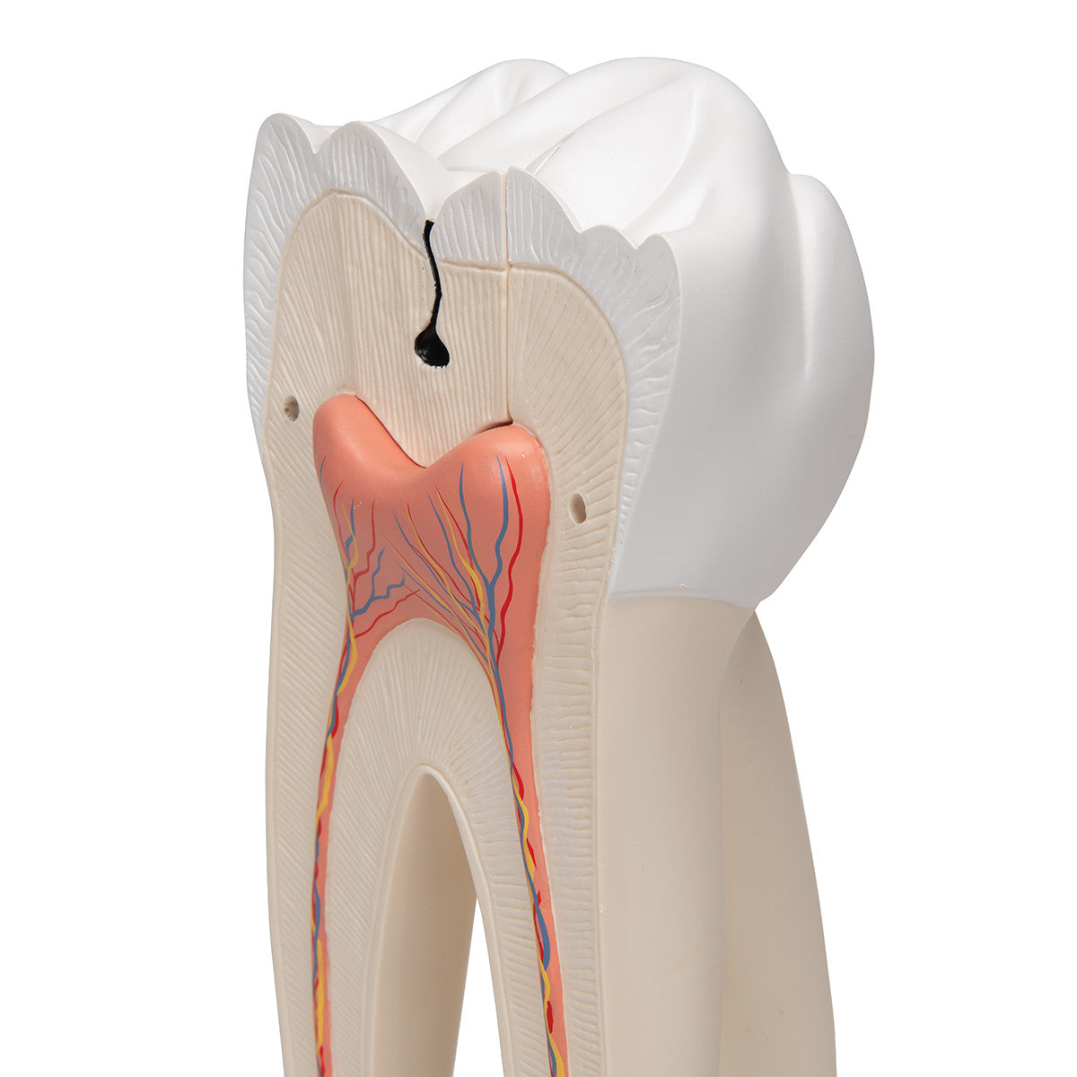 Giant Molar with Dental Cavities Human Tooth Model, 15 times Life-Size, 6 part
