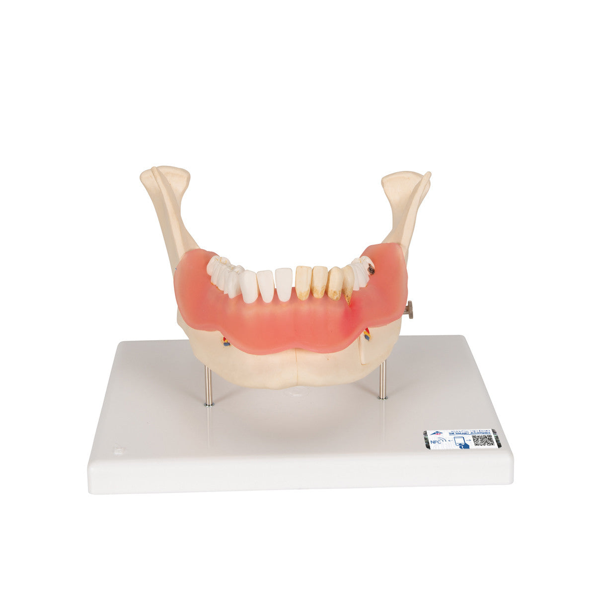 Dental Disease Model, Magnified 2 times, 21 parts