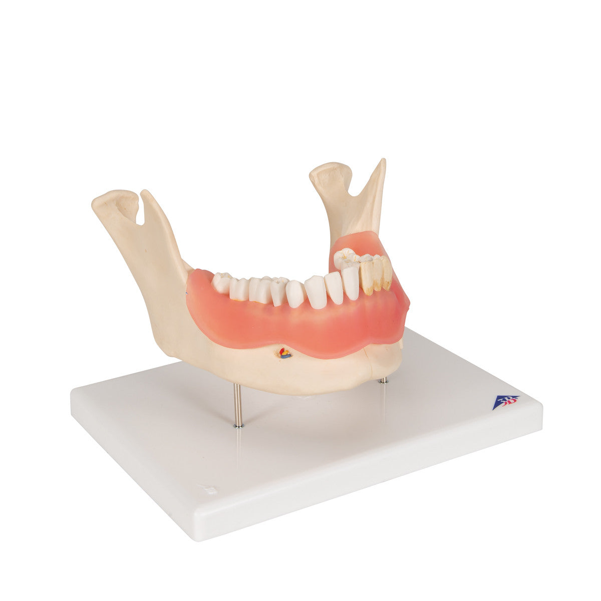 Dental Disease Model, Magnified 2 times, 21 parts