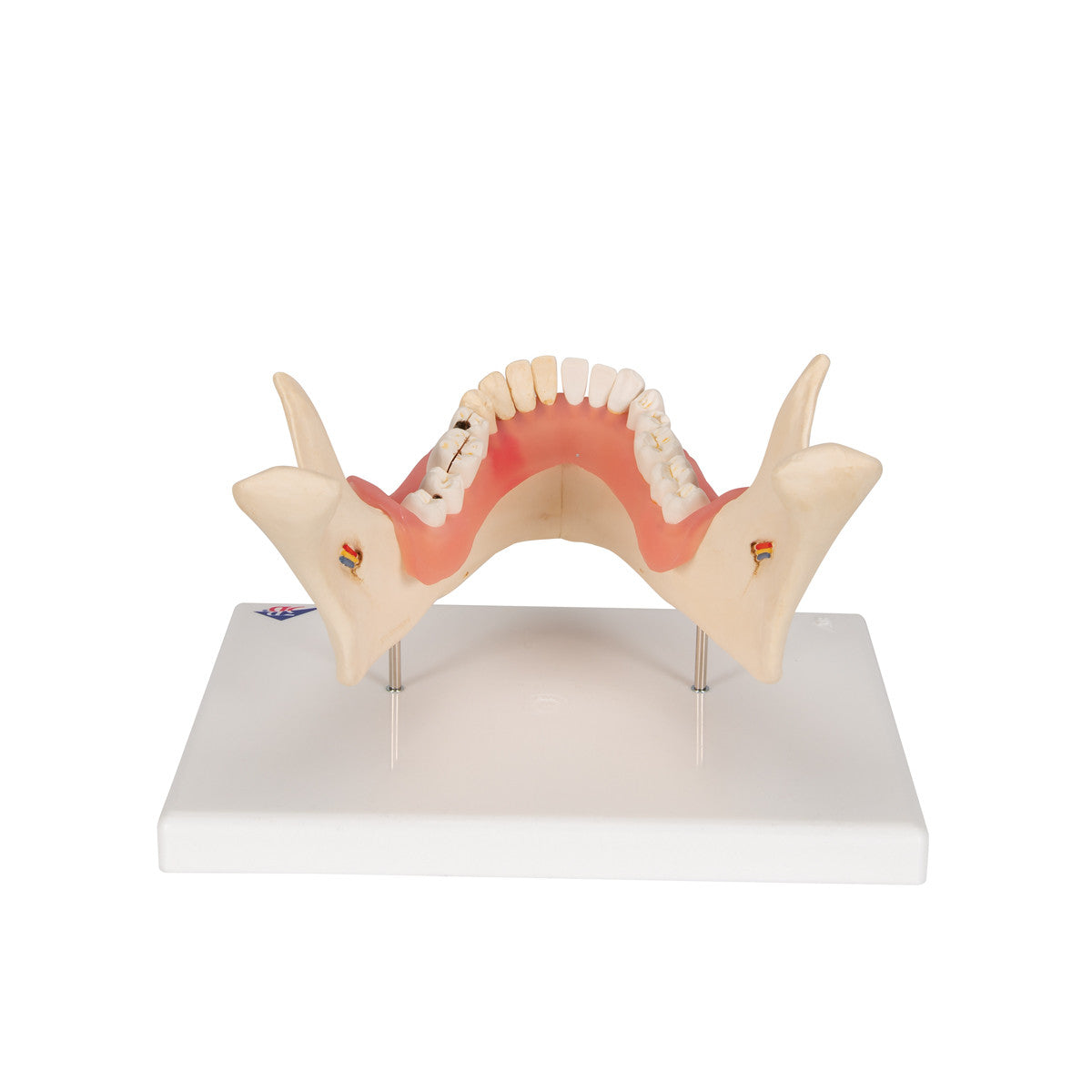 Dental Disease Model, Magnified 2 times, 21 parts