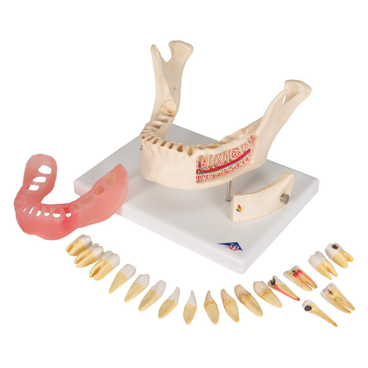Dental Disease Model, Magnified 2 times, 21 parts