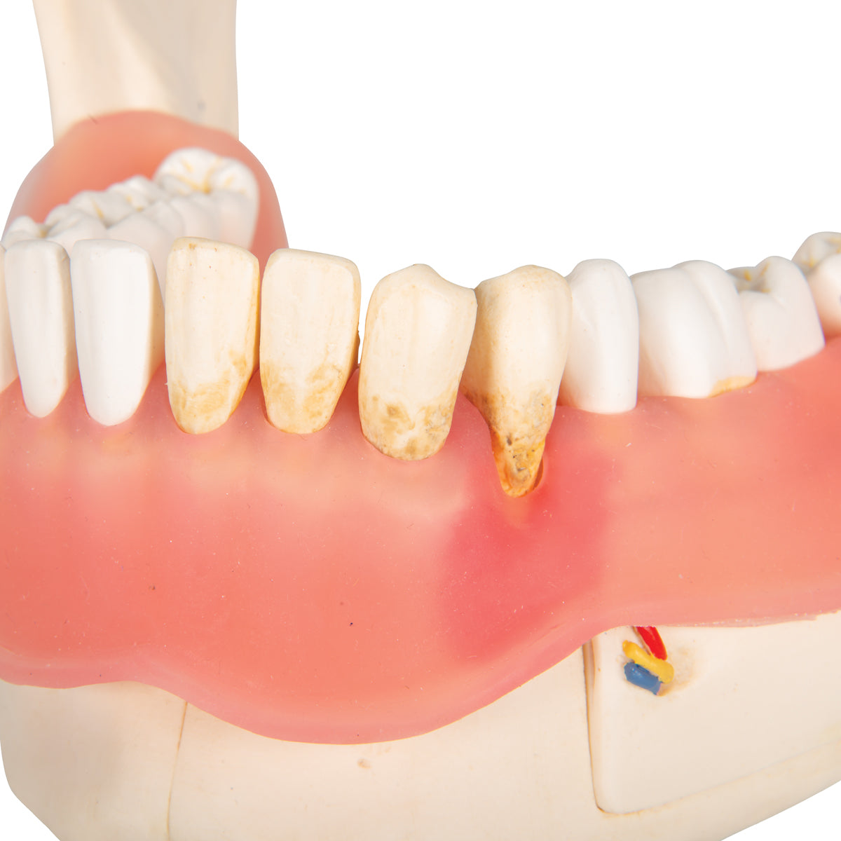 Dental Disease Model, Magnified 2 times, 21 parts - 3B Scientific D26, view 5