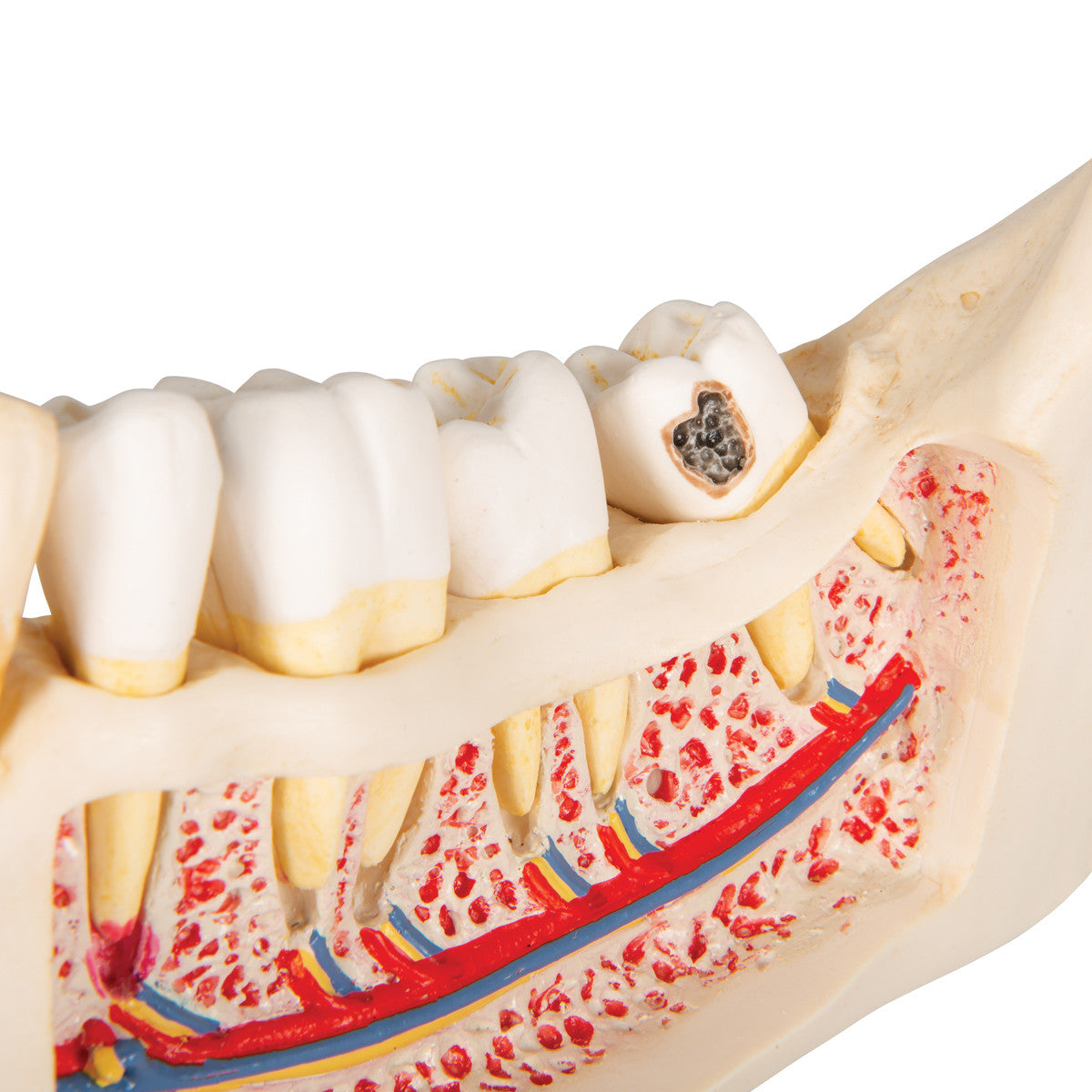 Dental Disease Model, Magnified 2 times, 21 parts