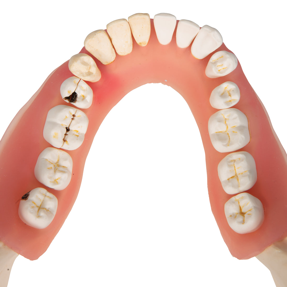 Dental Disease Model, Magnified 2 times, 21 parts - 3B Scientific D26, view 7