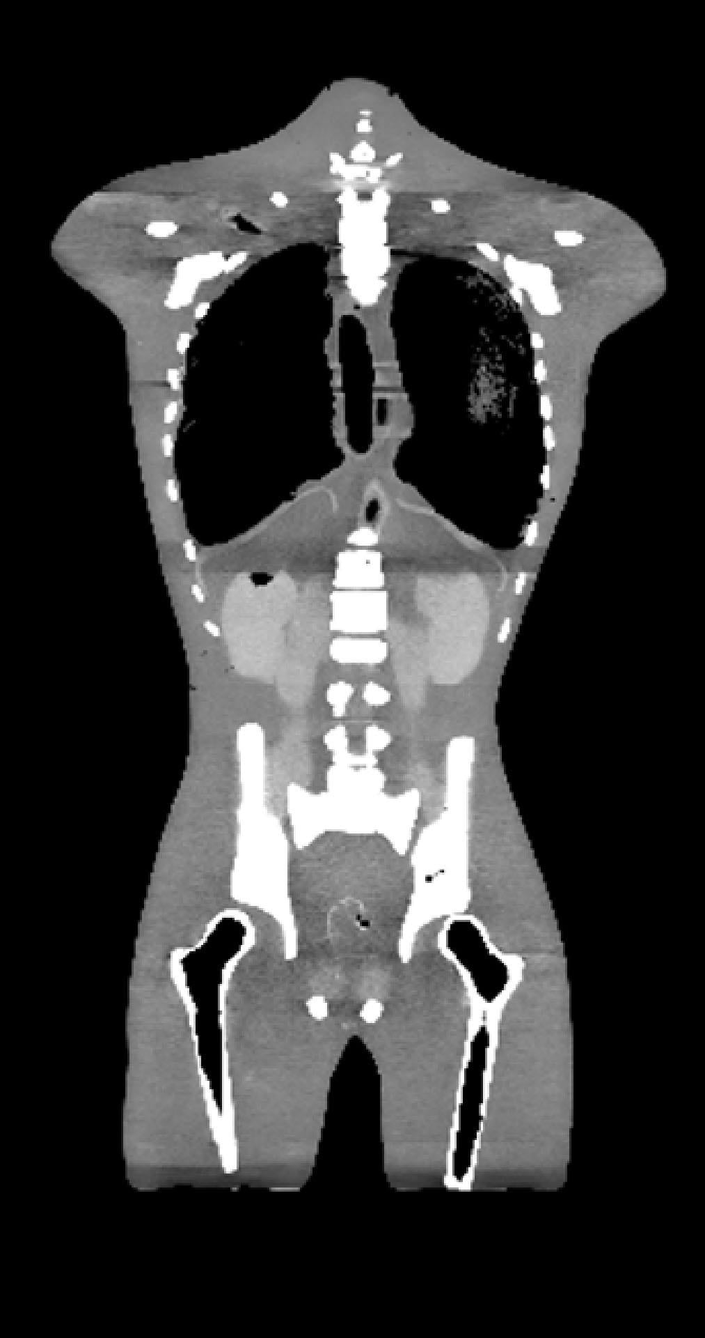 Adult Torso for X-Ray CT and US - Erler-Zimmer FLU02, view 3