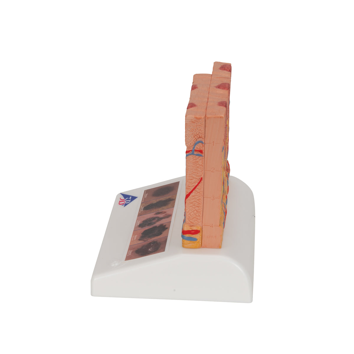 Skin Cancer Model with 5 stages, 8 times magnified