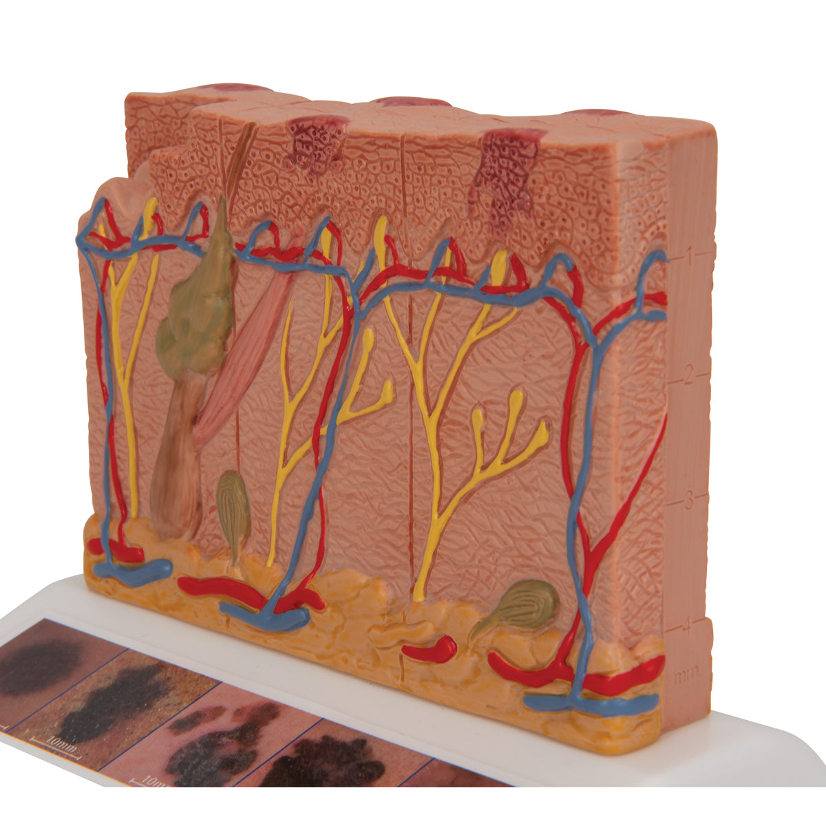 Skin Cancer Model with 5 stages, 8 times magnified