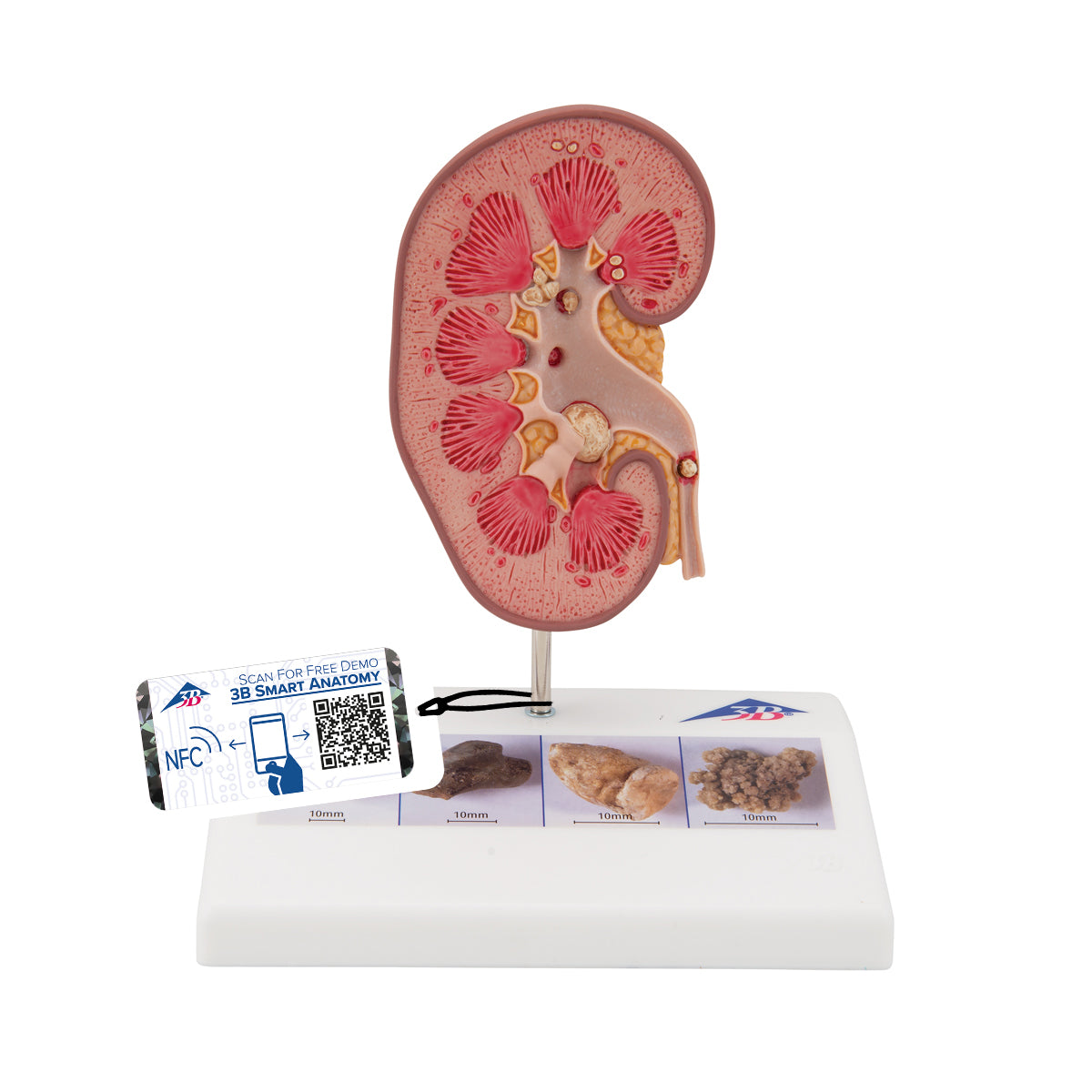 Kidney Stone Model - 3B Scientific K29, view 8