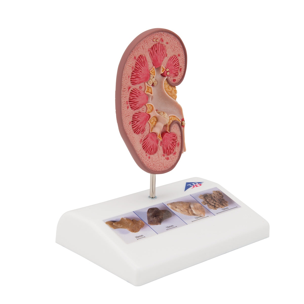 Kidney Stone Model - 3B Scientific K29, view 9