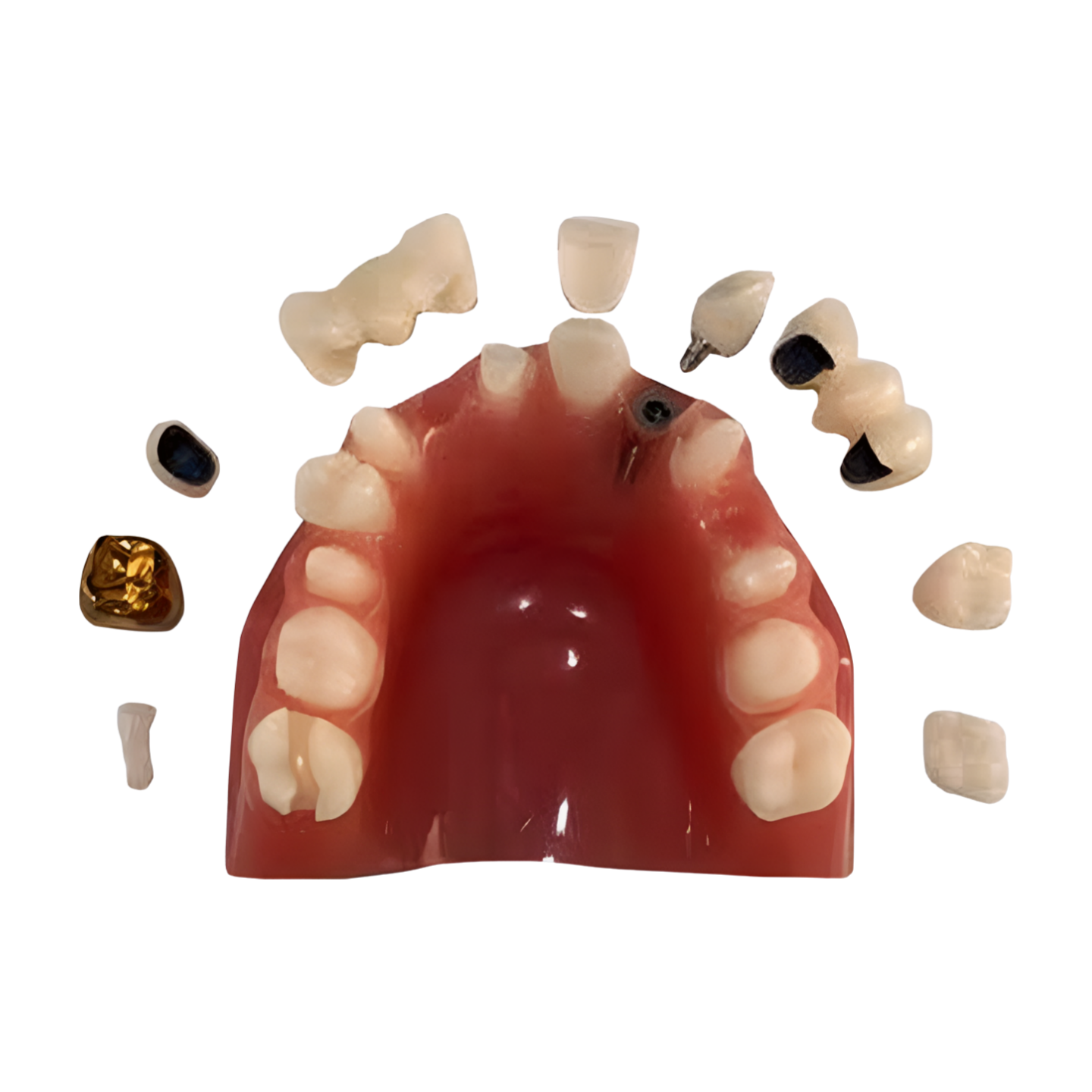 MKI.349 – Cosmetic Crown and Bridge Model