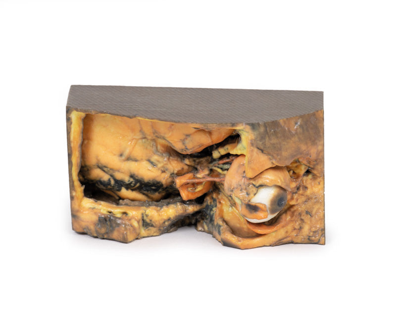 Lateral Orbit - 3D Printed Cadaver