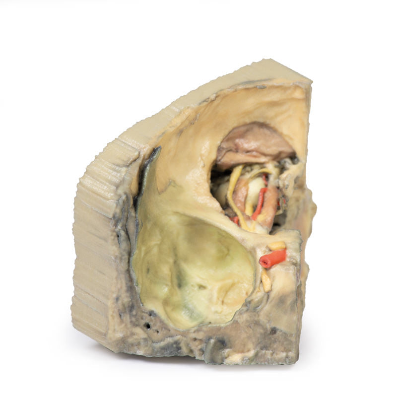 Medial Orbit - 3D Printed Cadaver