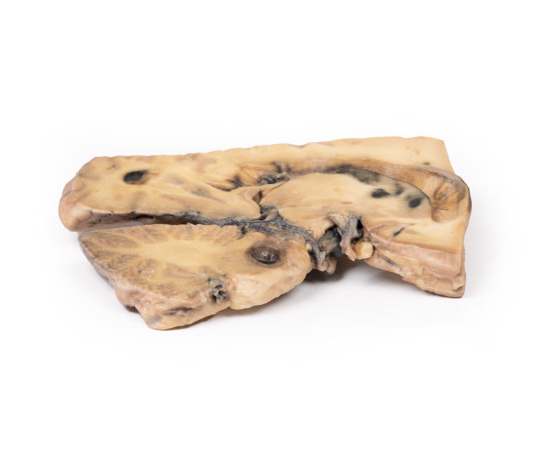 Berry Aneurism of Basilar Artery