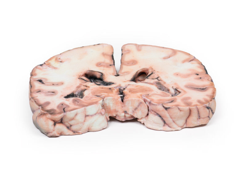 Glioma grade 3-4, causing papilloedema