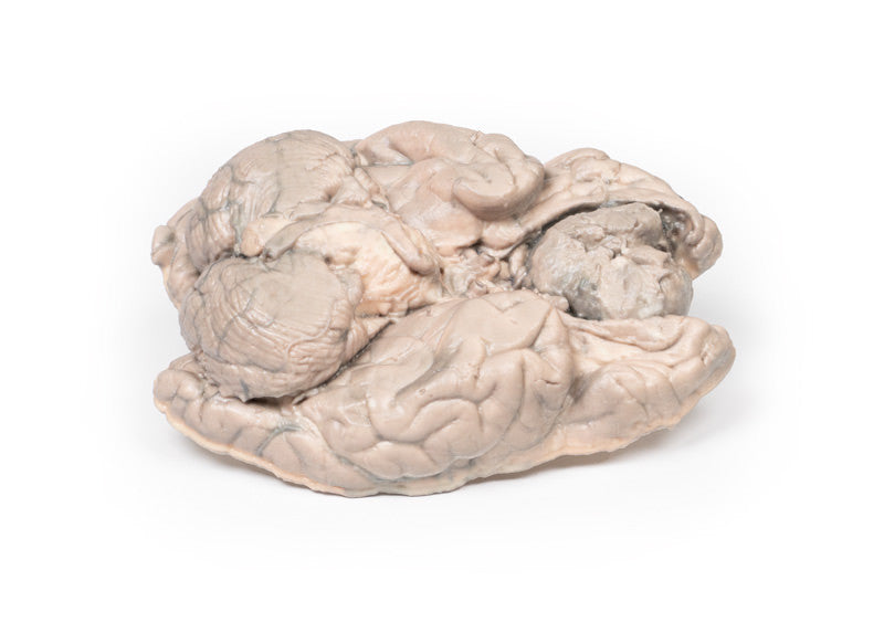 Meningioma