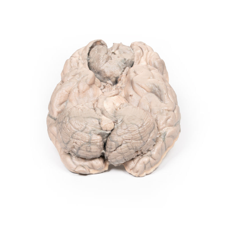 Meningioma