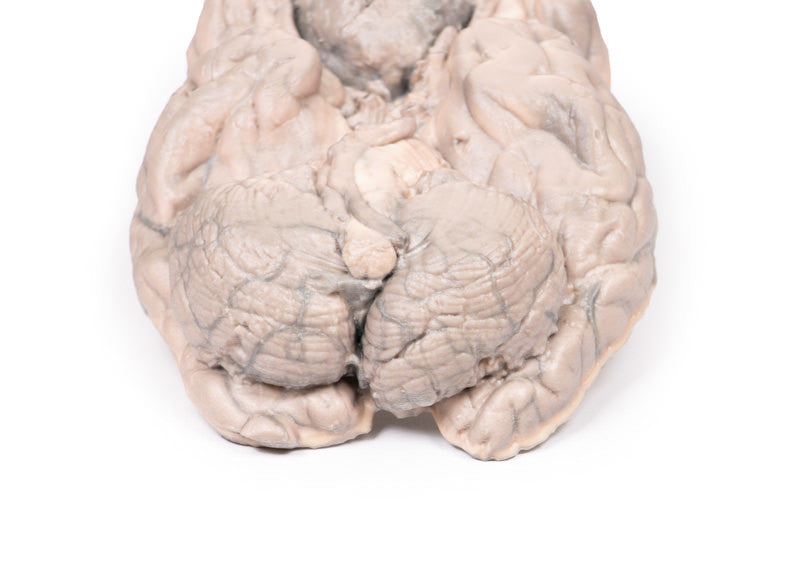 Meningioma