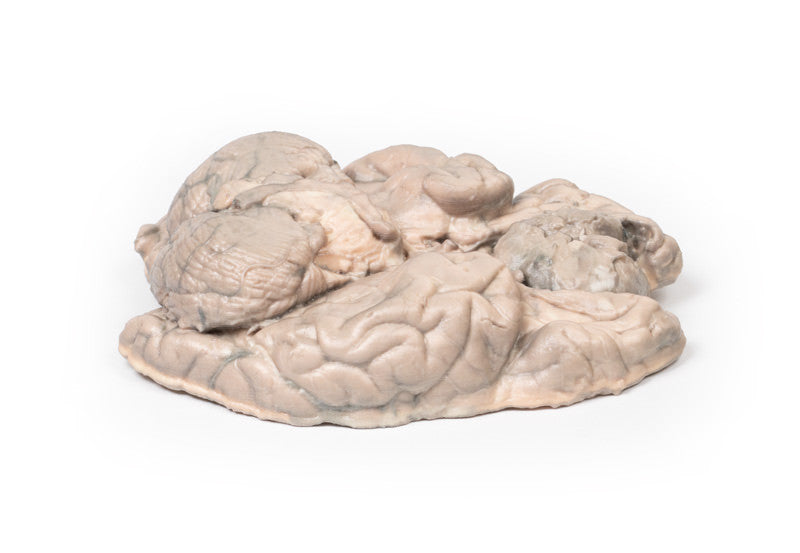 Meningioma