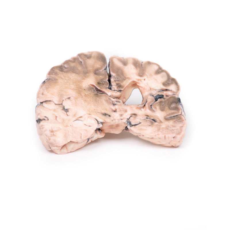 Left cerebral infarct