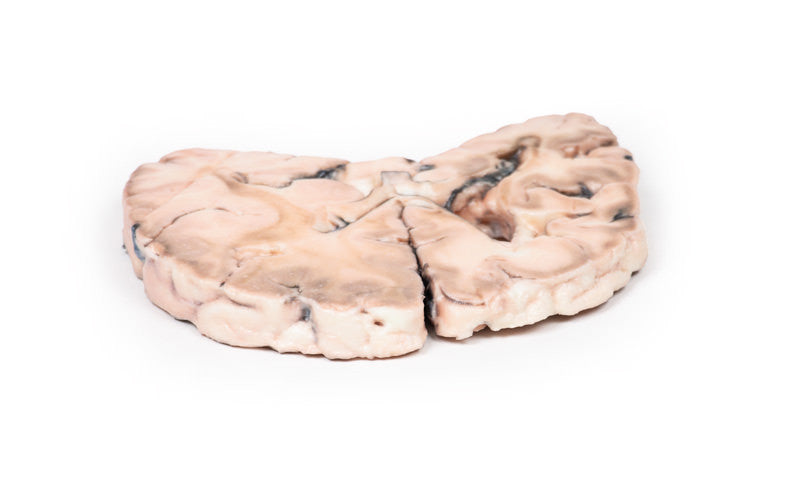 Left cerebral infarct