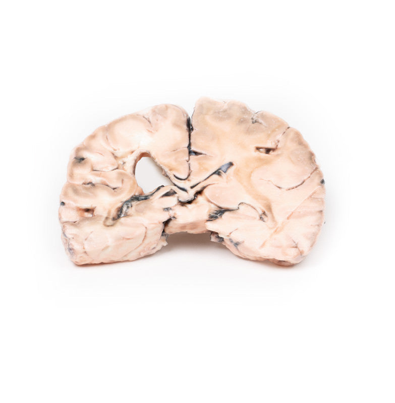 Left cerebral infarct