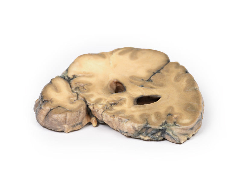 Metastatic Adenocarcinoma in the Brain