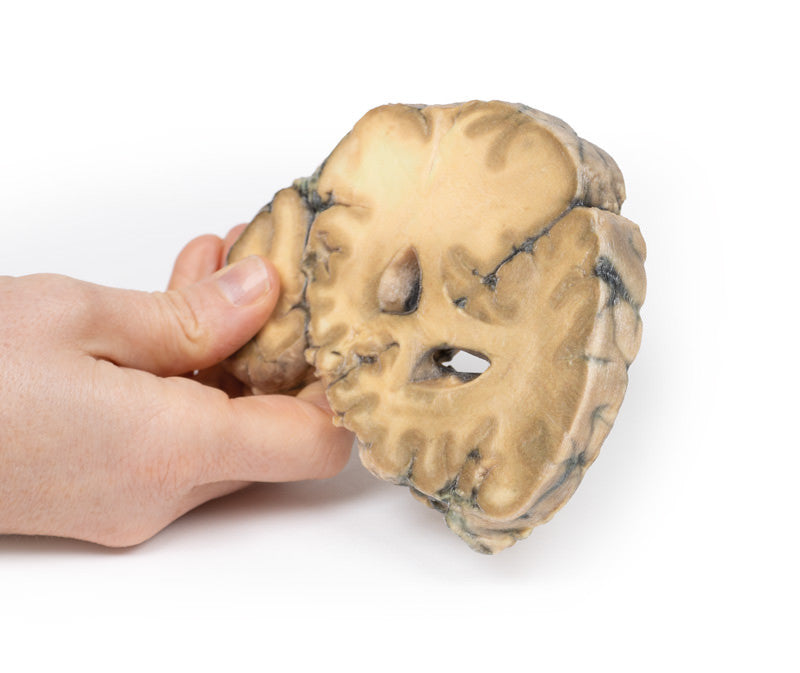 Metastatic Adenocarcinoma in the Brain