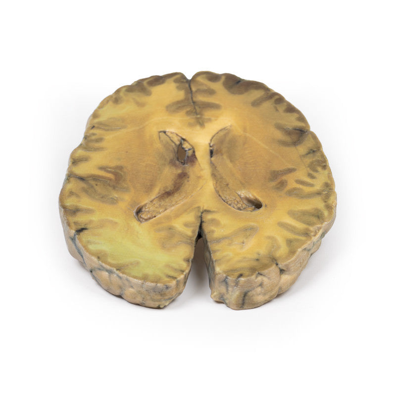 Ventriculitis, Secondary to Septicaemia