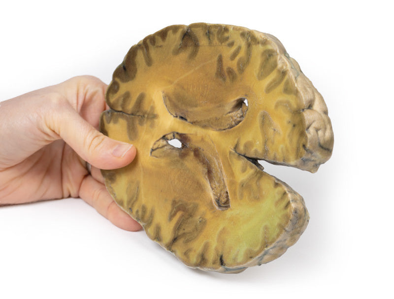 Ventriculitis, Secondary to Septicaemia