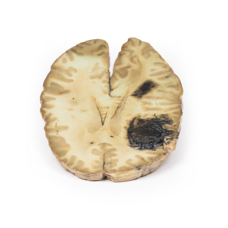 Cerebral Haemorrhage, secondary to Acute Myeloid Leukaemia