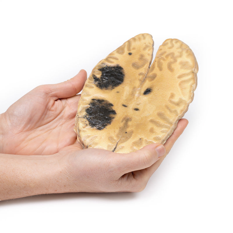 Cerebral Haemorrhage, secondary to Acute Myeloid Leukaemia