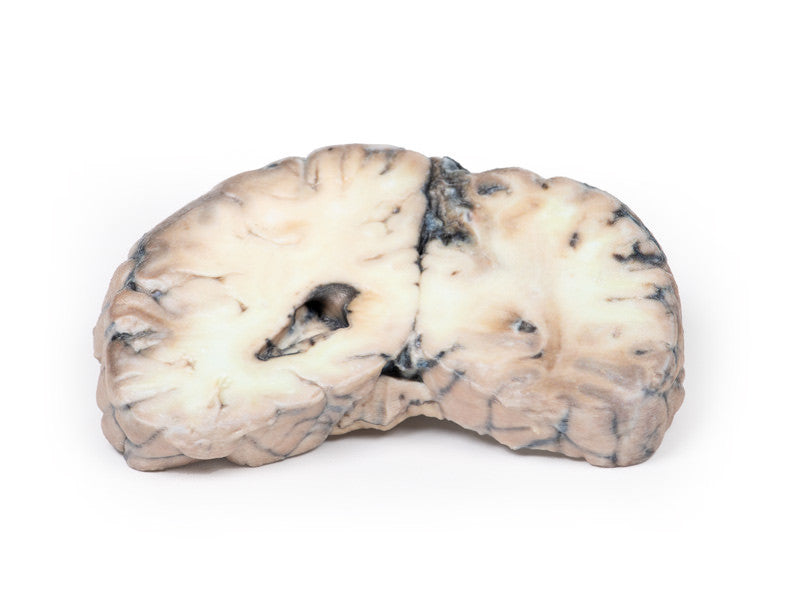 Cerebral Arterio-Venous Malformation