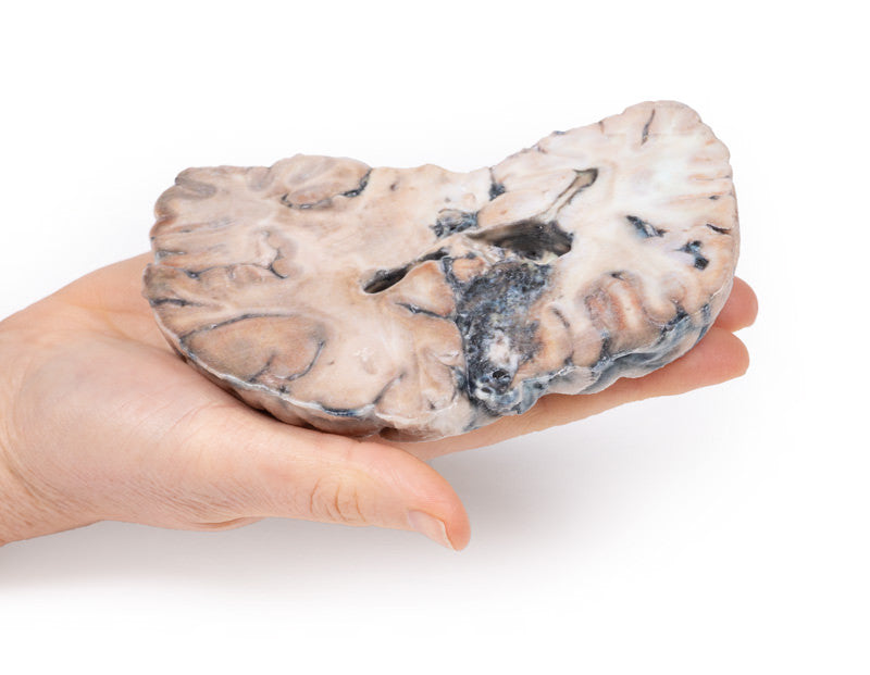 Cerebral Arterio-Venous Malformation